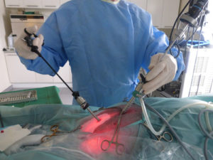 laparoscopische-sterilisatie